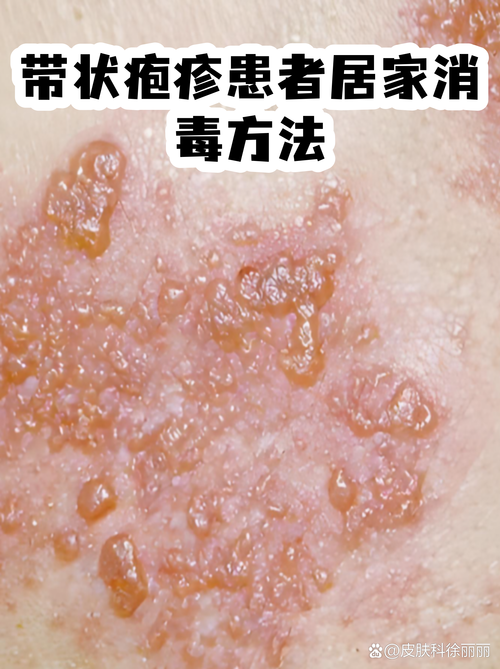 带状疱疹患者居家消毒方法